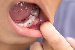 歯の生え変わり時のトラブル